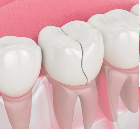 Dental implants illustration showing white crowns on pink gum tissue against pink background.