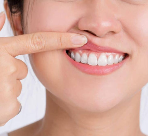 Woman pointing to her white teeth while smiling, demonstrating dental health and care results.