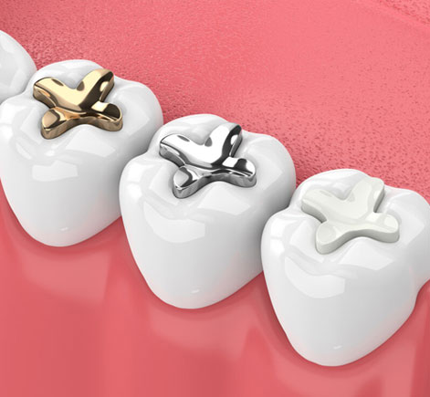 Three white dental crowns on pink background, two with gold and silver clasps, one plain.