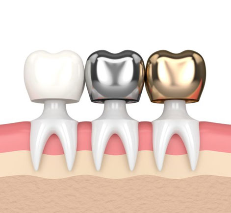 Three dental crowns displayed on tooth models showing white ceramic, silver metal, and gold options.