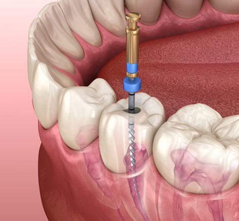 Dental professional performing root canal treatment on tooth with syringe and anesthetic injection.