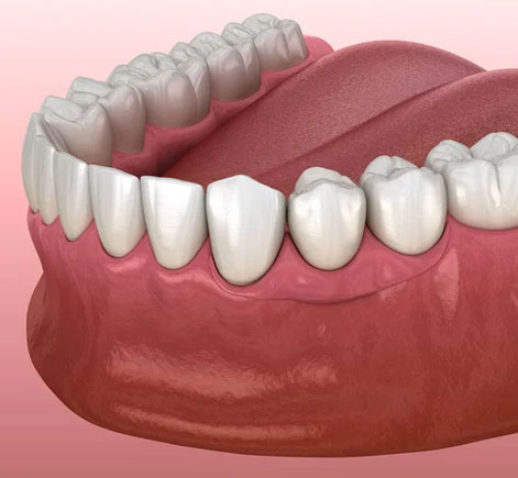 3D dental model showing upper and lower teeth with gum tissue against pink background.