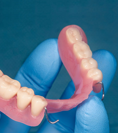 Dental prosthetic being held in hands wearing blue gloves against blue background.