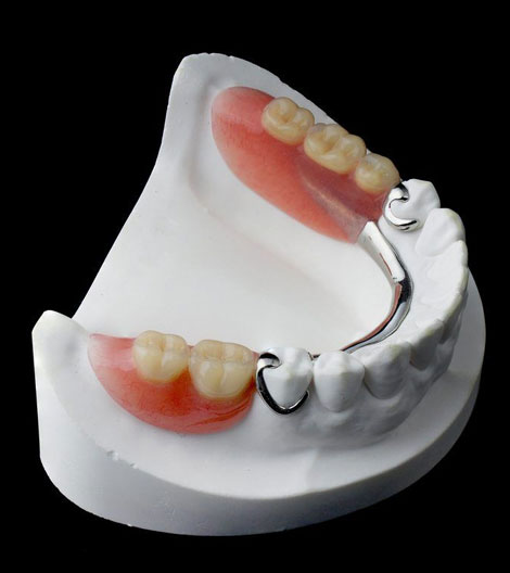 Dental prosthetic model showing upper and lower dentures with tooth-colored crowns on white base.