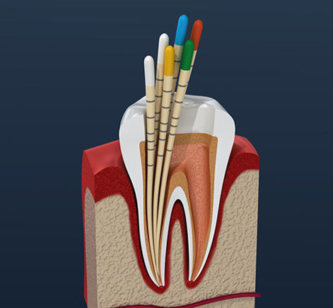 Anatomical diagram of tooth cross-section showing internal structure, pulp, and nerves against dark background.