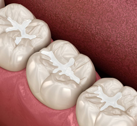 Three dental crowns or restorations displayed against pink background showing occlusal surfaces.