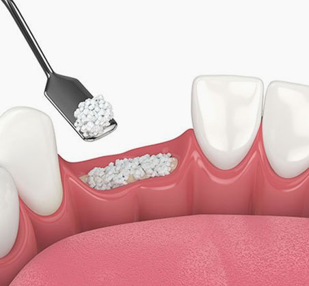 Dental illustration showing tooth cleaning with brush removing plaque buildup between teeth and gums.