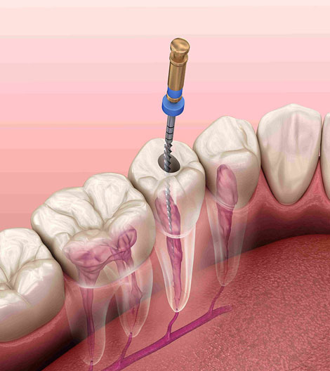 Dental implant procedure illustration showing tooth anatomy with surgical drill on pink background.