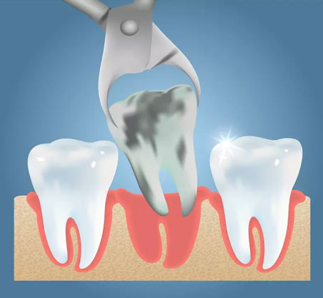 Dental extraction illustration showing forceps removing a tooth from gum between two healthy teeth.
