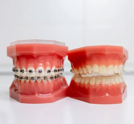 Two dental models displaying orthodontic braces and teeth alignment on white surface.